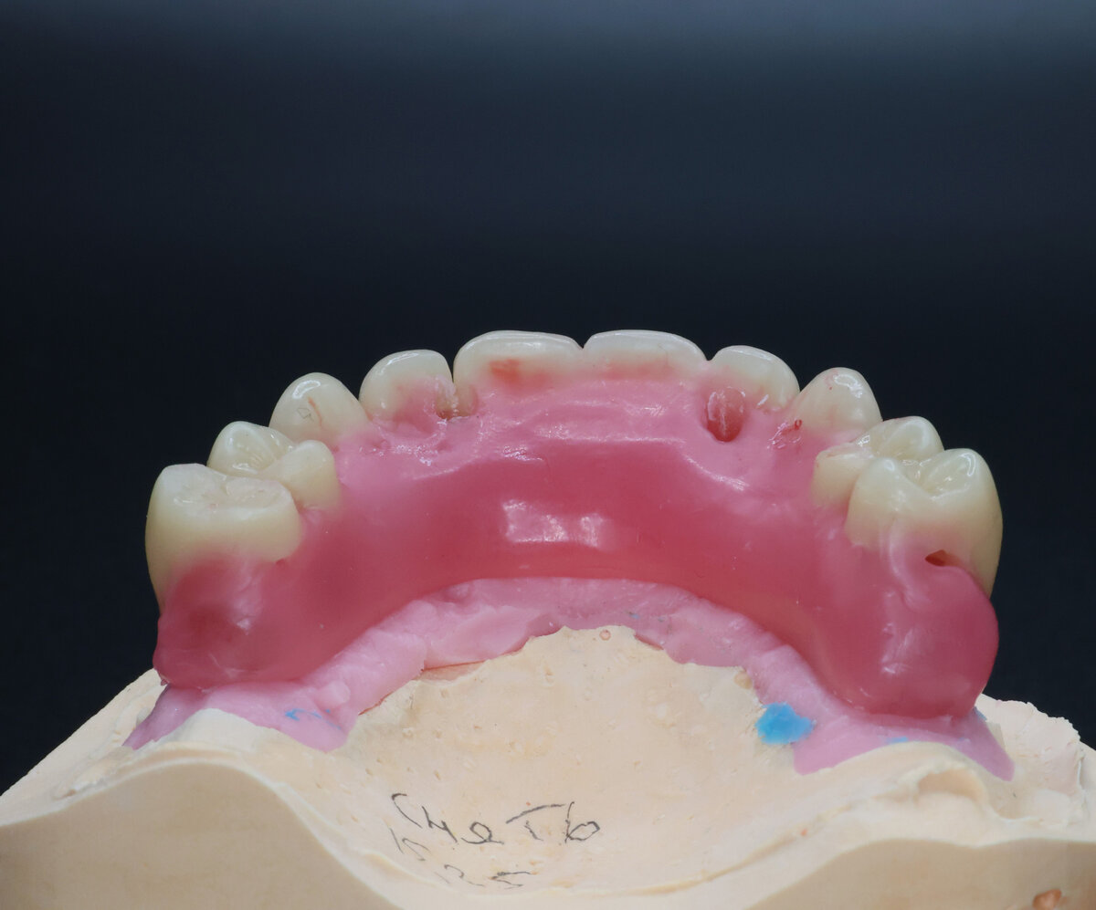 зубные протезы примерка. микропротезы виниры вкладки стоматология. керамическая культевая вкладка. зубные протезы примерка. зубные протезы примерка.