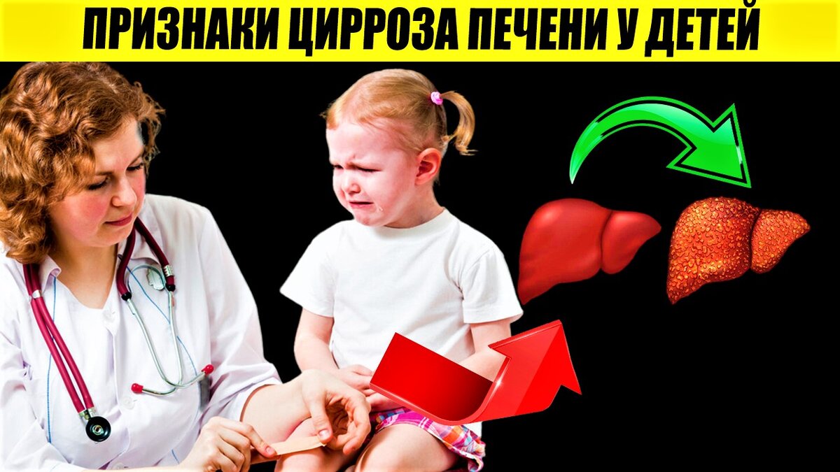 Признаки Цирроза Печени у Детей