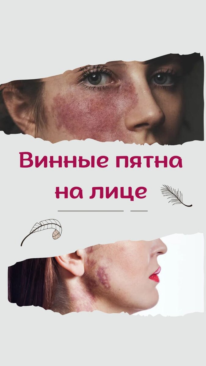 Удаление винных пятен лазером | Фрау Клиник | Дзен