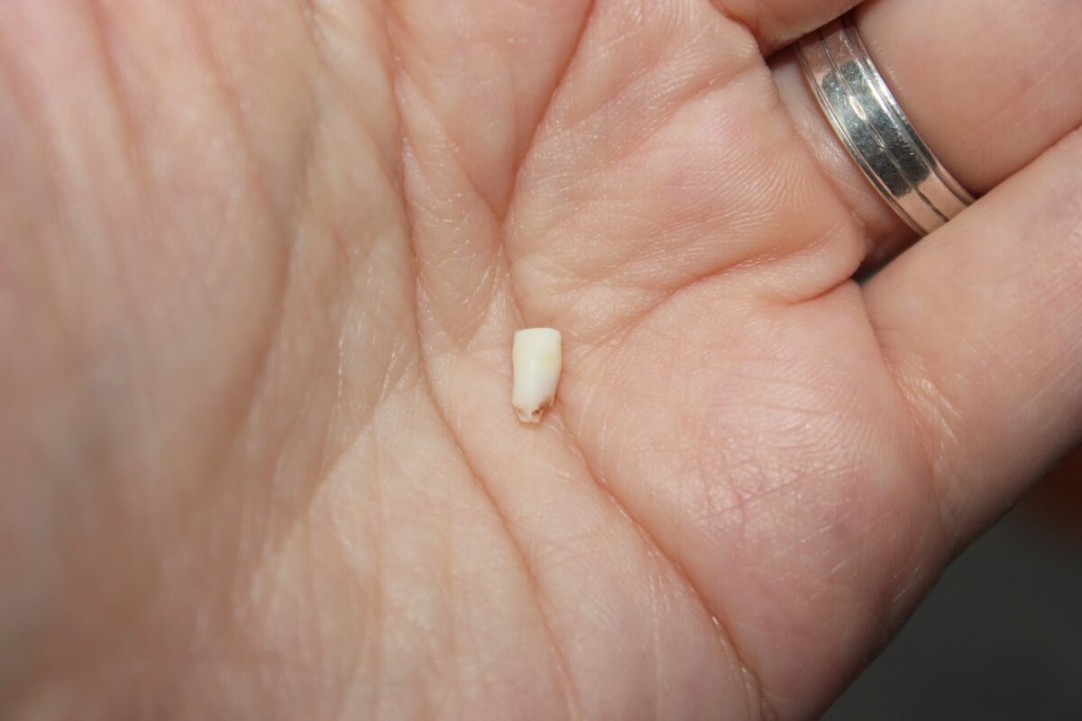 К чему снится зуб раскрошился без крови. Выпавший передний молочный зуб. Как выглядит молочный зуб.