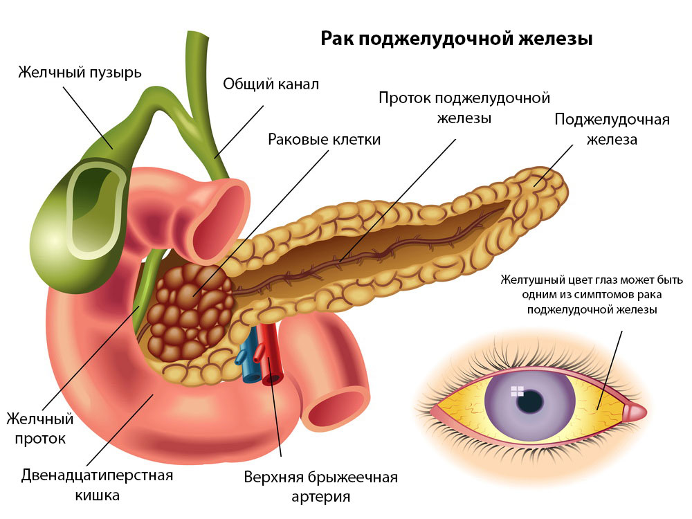 Поджелудочная железа желчный пузырь анатомия. Желчный пузырь и поджелудочная железа. Раковая опухоль поджелудочной железы. Санториниев проток поджелудочной железы.