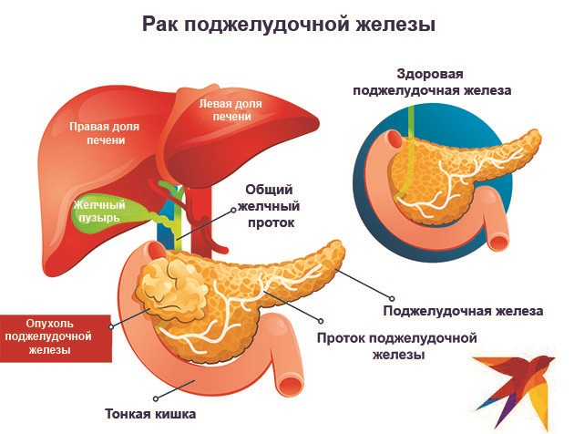 Рак поджелудочной признаки и симптомы. Головка поджелудочной железы. Раковая опухоль поджелудочной железы. Опухоль головки поджелудочной. Онкология поджелудочной.