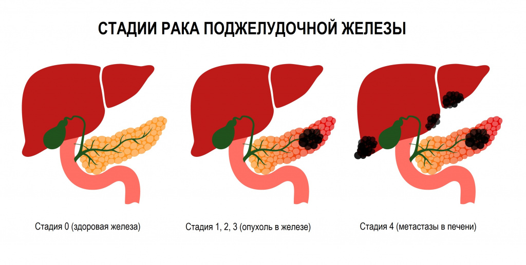 Стадии онкологии поджелудочной железы. Протоковая карцинома поджелудочной железы. Злокачественный поджелудочной железы.