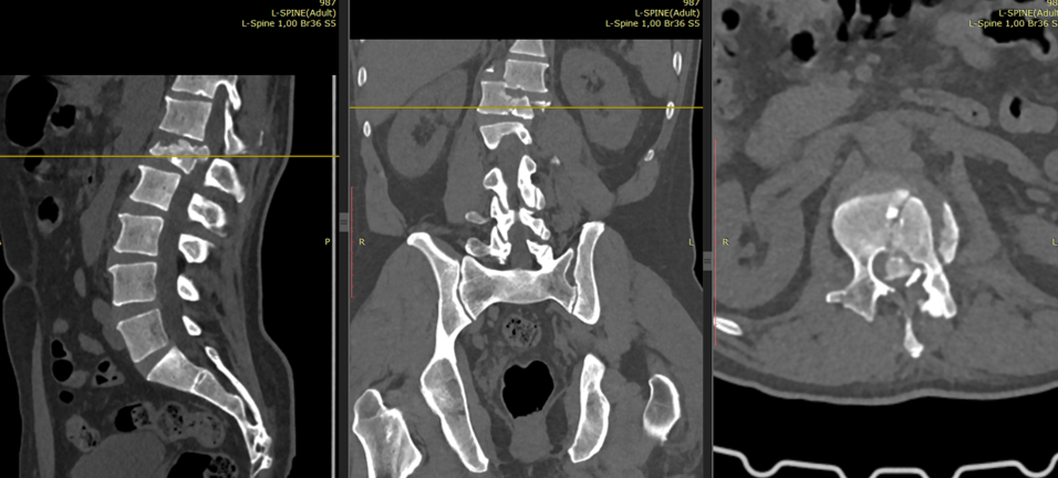 Дообследования выявили комбинацию тяжёлых повреждений позвоночника