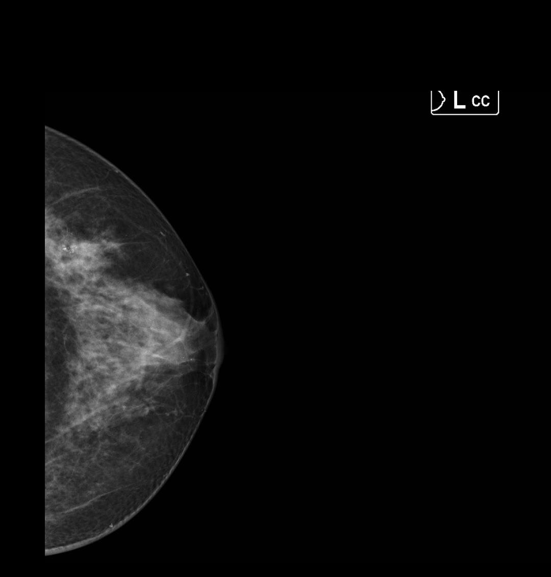 Продолжение о важности диагностического фокуса | Маммология и хирургия ...