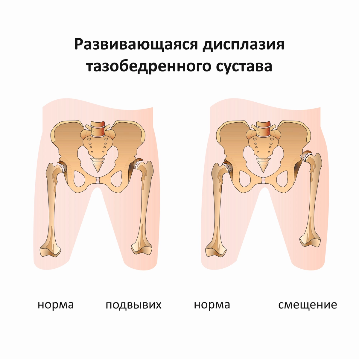 Дисплазия тазобедренного сустава — Википедия