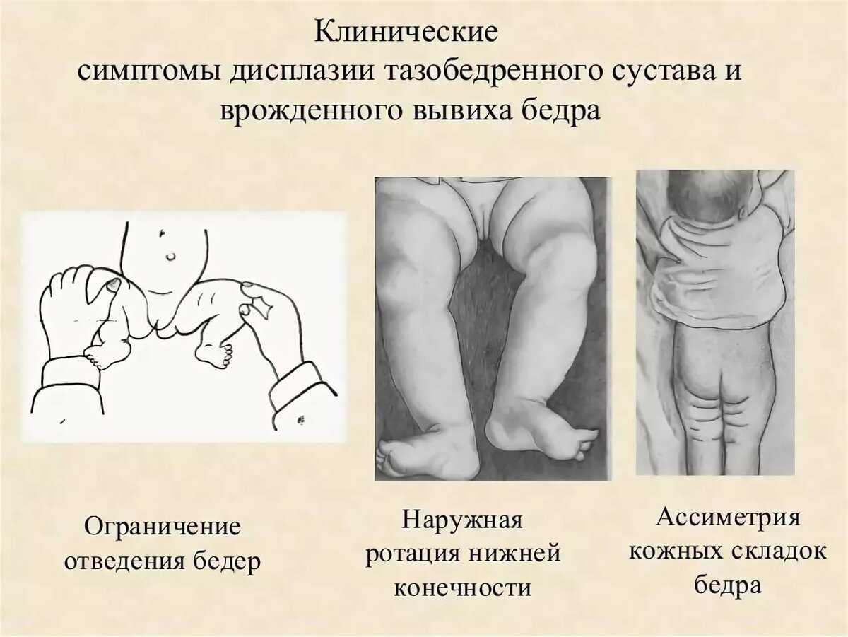 Тазобедренный сустав: функциональные нарушения и лечение