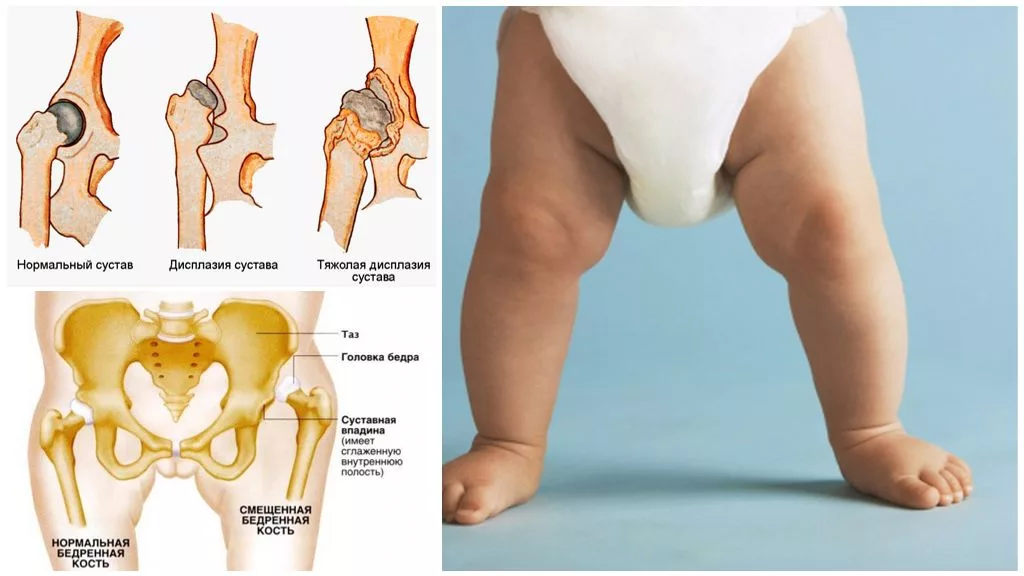 Дисплазия тазобедренного сустава | Лечение дисплазии ТБС у детей и взрослых ᐉ Ladisten