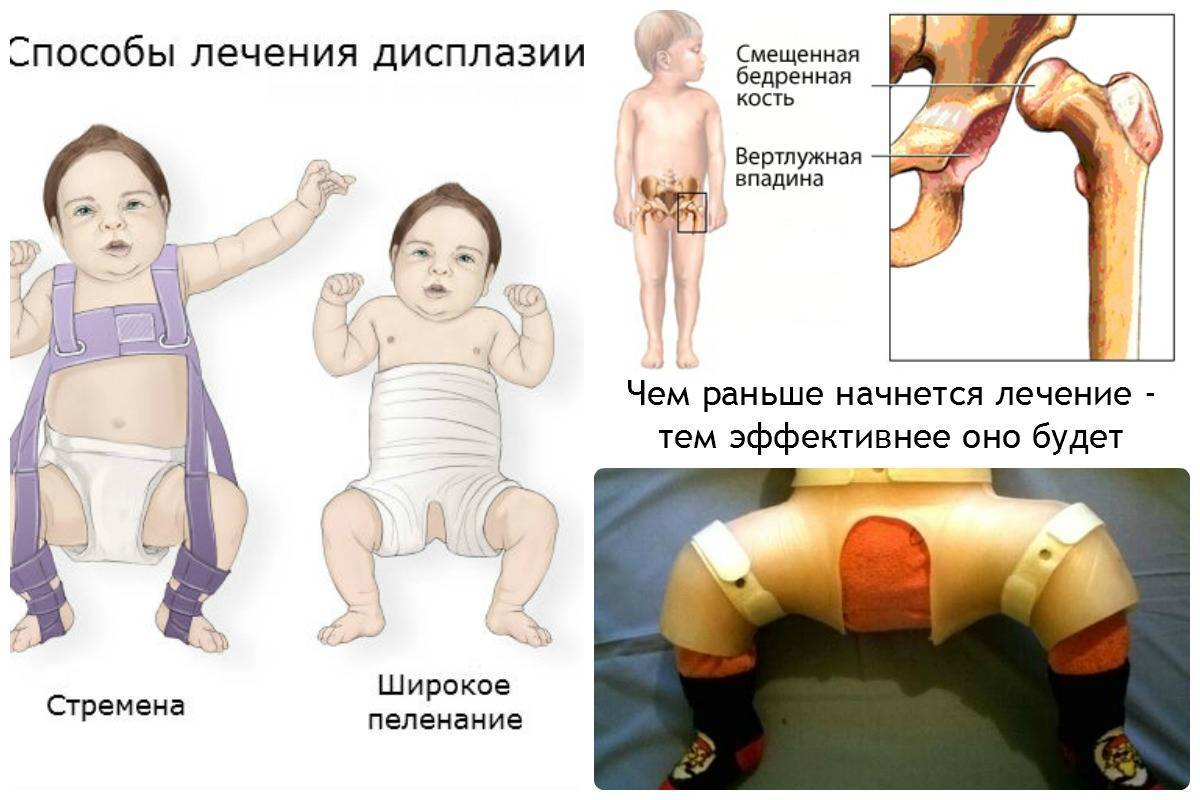 Болезни тазобедренного сустава у детей. Врождённая дисплазия ТБС. Дисплазия тазобедренных суставов 3ст. 2х сторонняя дисплазия тазобедренных суставов. Врождённый вывих бедра дисплазия.