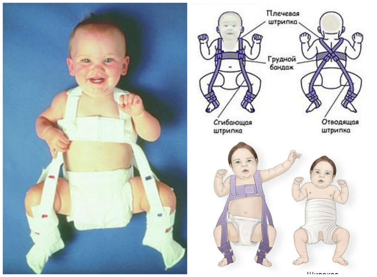 Дисплазия тазобедренного сустава (ДТБС) – почему это опасно и как нужно  лечить ребенка | О детском здоровье: с врачебного на родительский | Дзен