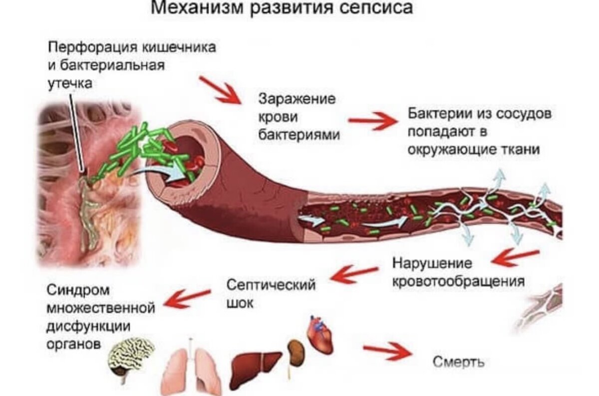 Пути инфицирования сепсис. CTG В си.