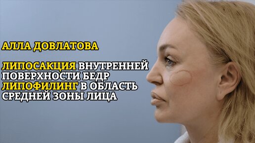 Алла Довлатова: липосакция внутренней поверхности бедер, липофилинг средней зоны лица!