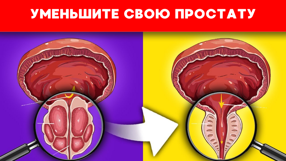 Как естественным образом уменьшить простату | Томаш Игорь | Pro ...
