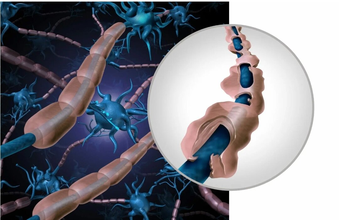 рассеянный склероз лекарства. противовирусные при рассеянном склерозе. лекарственные препараты при рассеянном склерозе. лечение рассеянного склероза препараты. патогенетическая терапия рассеянного склероза.