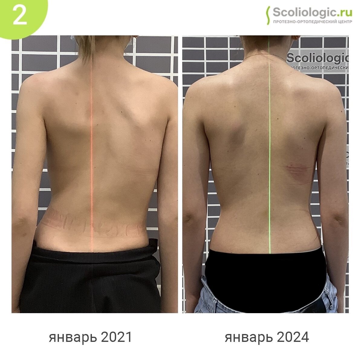 Степени сколиоза позвоночника классификация по чаклину. Сколиоз позвоночника 1 степени по чаклину. Люди с искривлением позвоночника. Классификация чаклина сколиоз. Степень сколиотической деформации.
