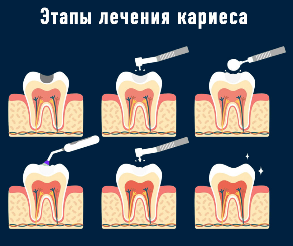 Активность кариозного процесса