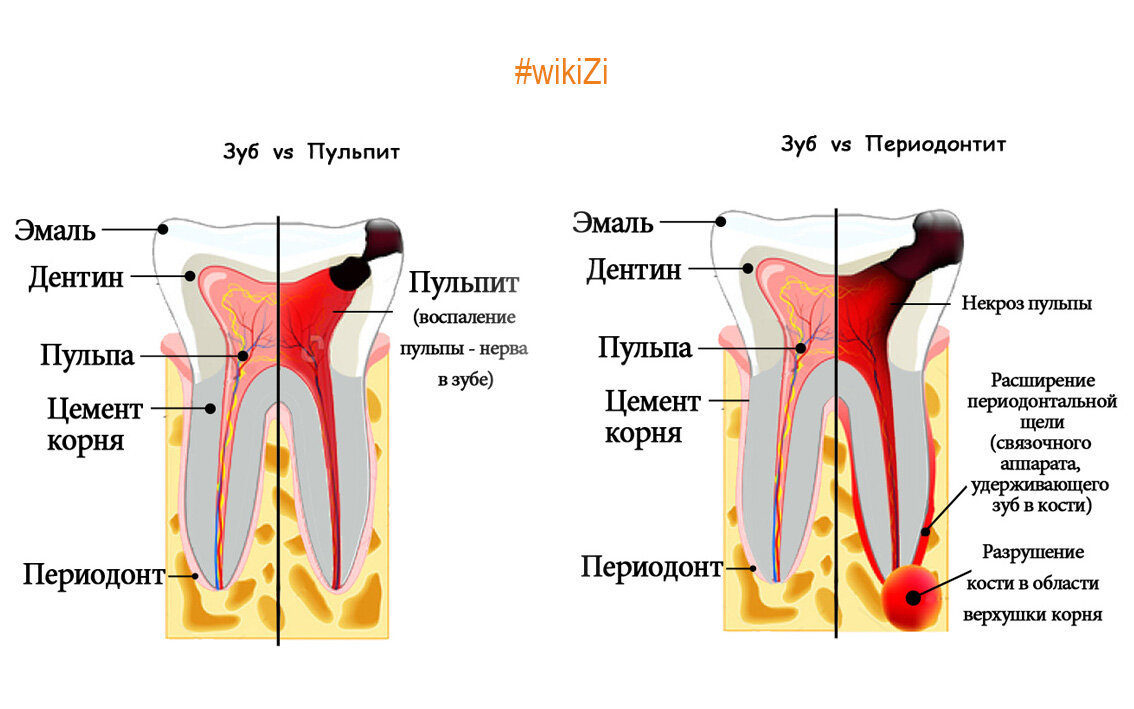 Лечение кариеса кальцием