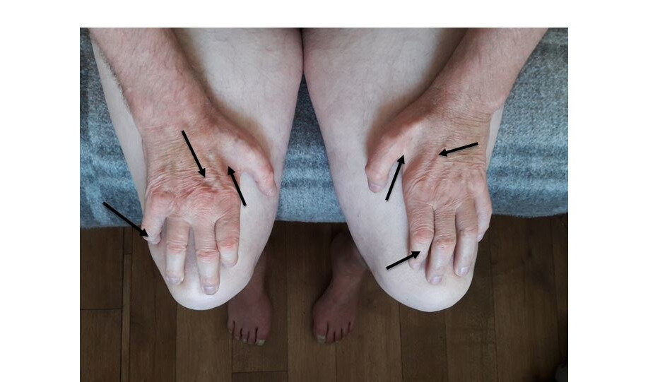 Признаки гипотрофии мышц верхних конечностей у пациента с полинейропатией Шарко–Мари–Тута. Собственный архив.