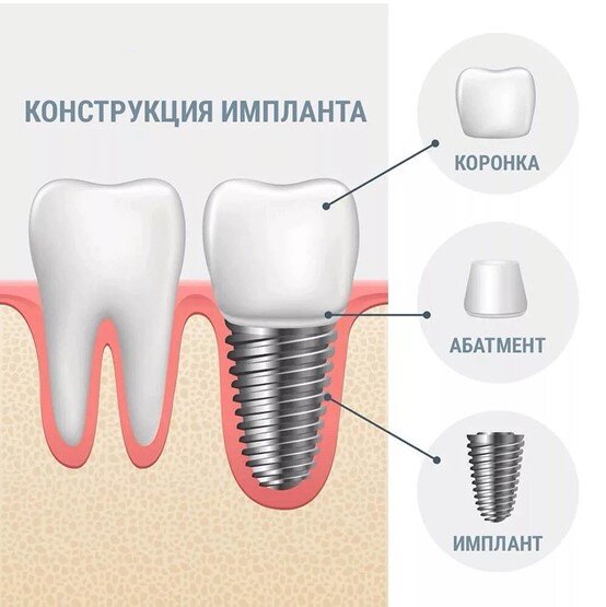 Имплантация 1 этап. Имплантация 1 этап