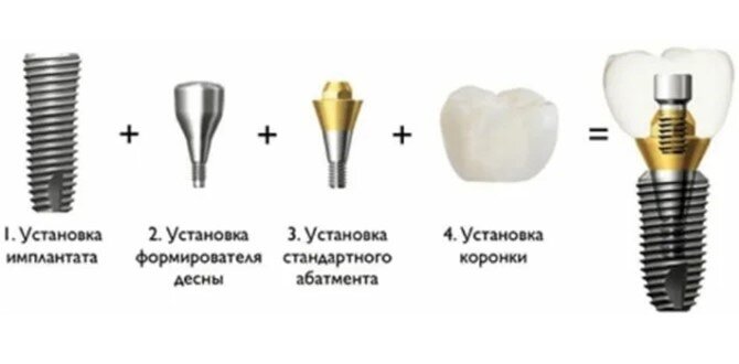 Как выглядит отторжение импланта зуба Сколько на самом деле стоит имплантация 1 зуба "под ключ"? Стоматология "Красивы