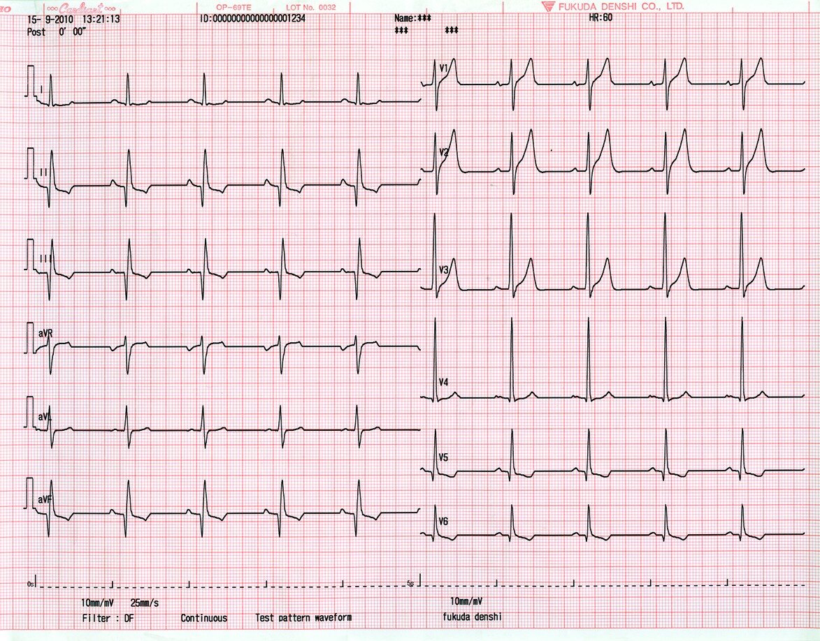 Нормальная ЭКГ В 12 отведениях 50. ЭКГ В 12 отведения нормальная ЭКГ. ЭКГ норма в 12 отведениях. ЭКГ 50 мм/с.
