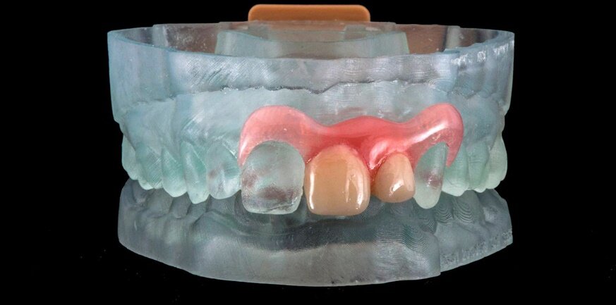 Ремонт зубных протезов рядом. Починка съемных пластиночных протезов. Починка пластмассовых протезов. Ремонт зубных протезов рядом. Ремонт протезов стоматология.