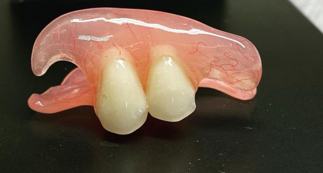 Съемный зуб бабочка. Микропротез бабочка на 1. Микропротез бабочка/ иммедиат-протез. Зубной микропротез бабочка.