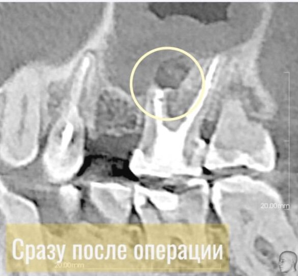 Зуб после проведения резекции