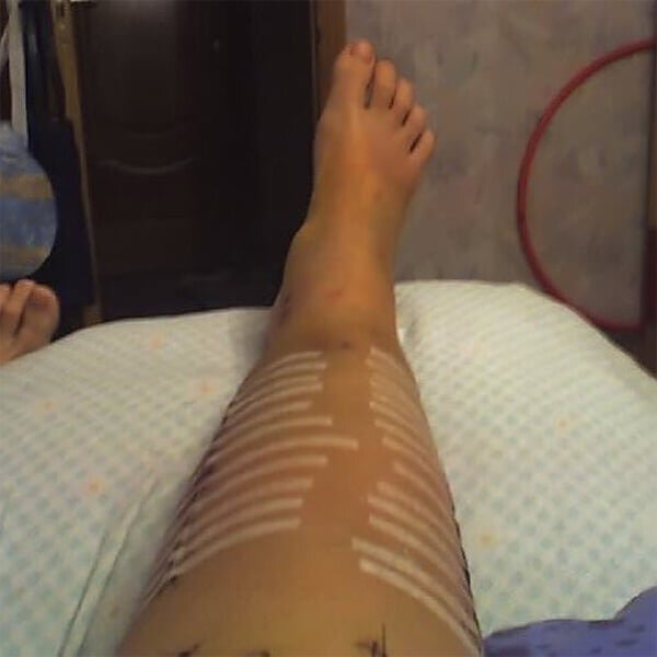 таблица выплат ущерб здоровью по осаго при дтп. сумма страховой выплаты при переломе ноги. сумма страховых выплат по осаго в 2020 году. выплата по страховой при переломе ноги. сумма выплаты при переломе ноги по страховки.