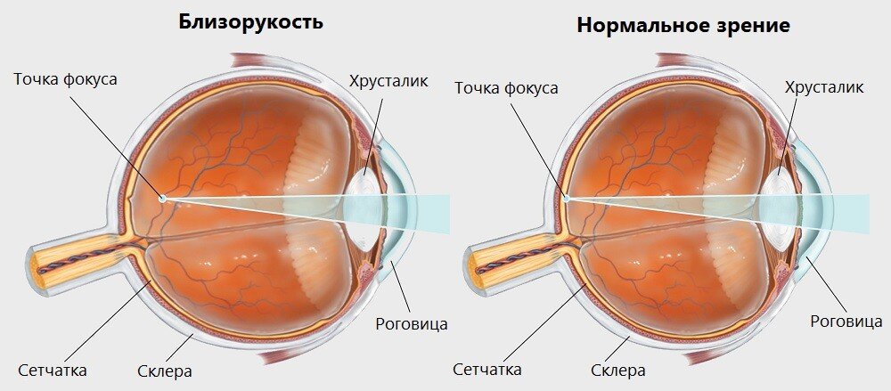 Зрение 7 как видит. Зрение минус. Зрение -2.5. Зрение минус 2. Минусы зрения человека.