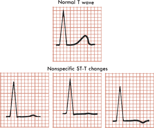 Вот тут легко понять, какие именно изменения сегмента ST и зубца Т называют "неспецифические" - для сравнения приведен "нормальный" зубец Т и сегмент ST