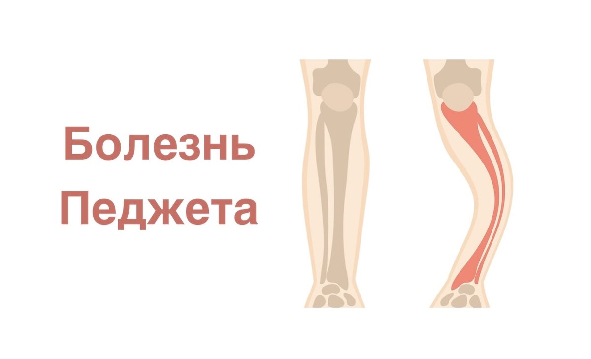  Болезнь Педжета (остеодистрофия) - хроническое заболевание костей скелета, при котором происходит усиление метаболизма костной ткани. Со временем кости могут стать хрупкими и деформироваться.