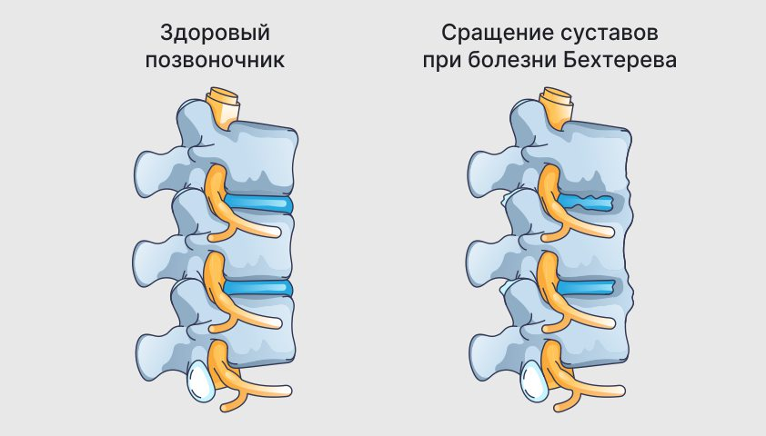 Изменения в позвоночнике при болезни Бехтерева