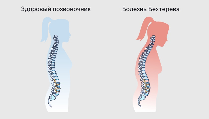 Болезнь Бехтерева - симптомы, причины и методы лечения в «СМ-Клиника»