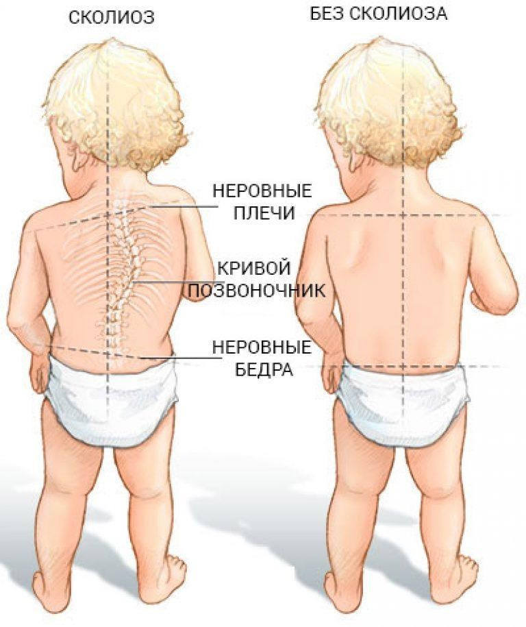 Как исправить искривление позвоночника?