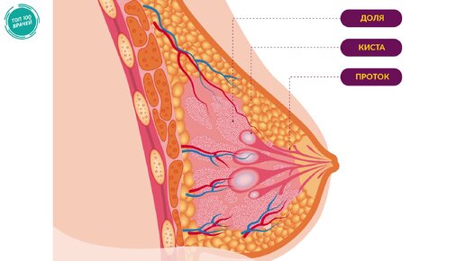 Киста молочной железы: симптомы и лечение кисты молочной железы у женщин. Болит ли киста в груди