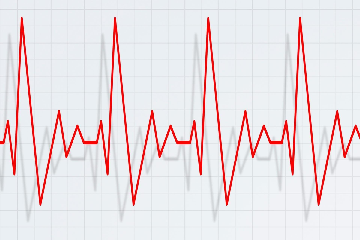 Сильный пульс причины. Тахикардия. Пульс. Учащение пульса. Диаграмма пульса.