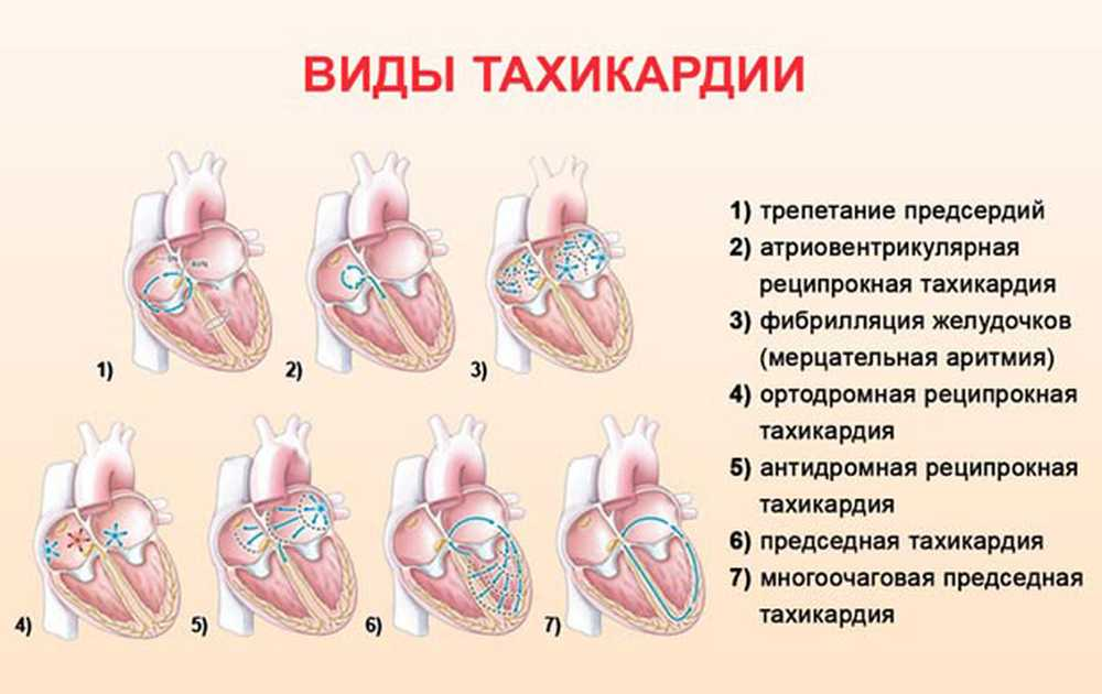 Сильный пульс причины. Тахикардия и другие заболевания сердца. Лечится ли тахикардия сердца. Тахикардия сердца что это такое и как лечить. Усиление сердцебиения.
