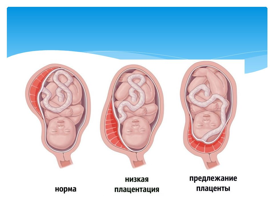 Низкая плацентация