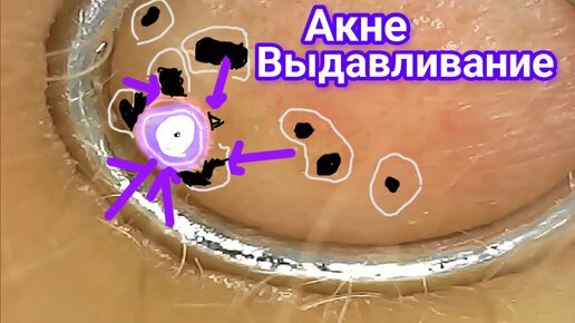 Лечение зубов под микроскопом в Новосибирске