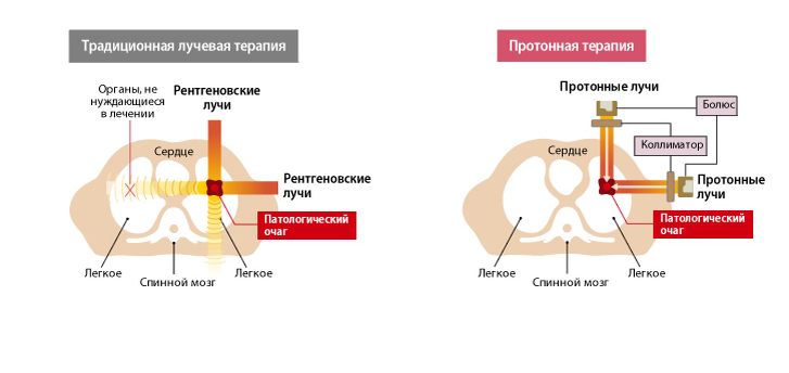 Лучевая терапия тошнота