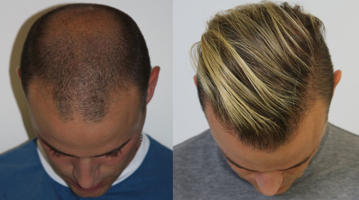 Пересадка 5 часов. Трансплантация волос до и после. До и после пересадки волос. Процедура пересадки волос. Пересадка 5 часов.