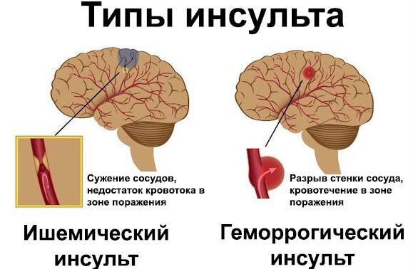 Инсульт представляет собой острое нарушение кровообращения в головном мозге, сопровождающееся гибелью тканей и нарушением функций нервной системы.