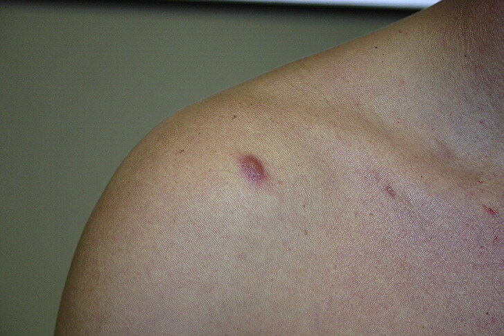 Фото из открытых источников. Внешний вид образования практически на 100% соответствует описанному мной случаю.