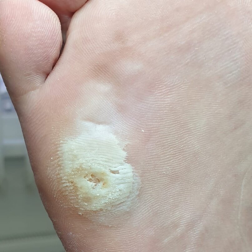 Ожёг после применения мозольного пластыря