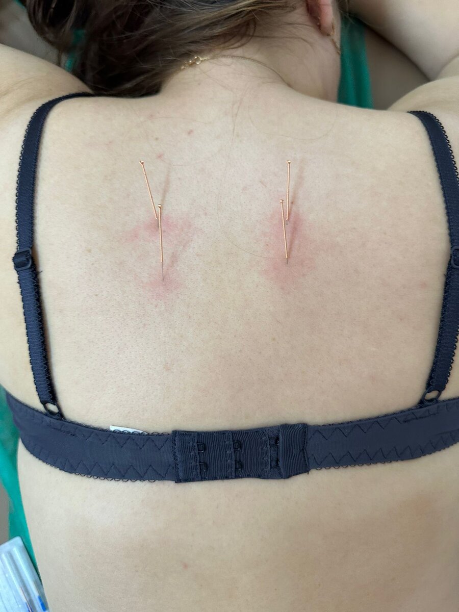 Иглы стоят в зонах, которые соответствуют работе сердца