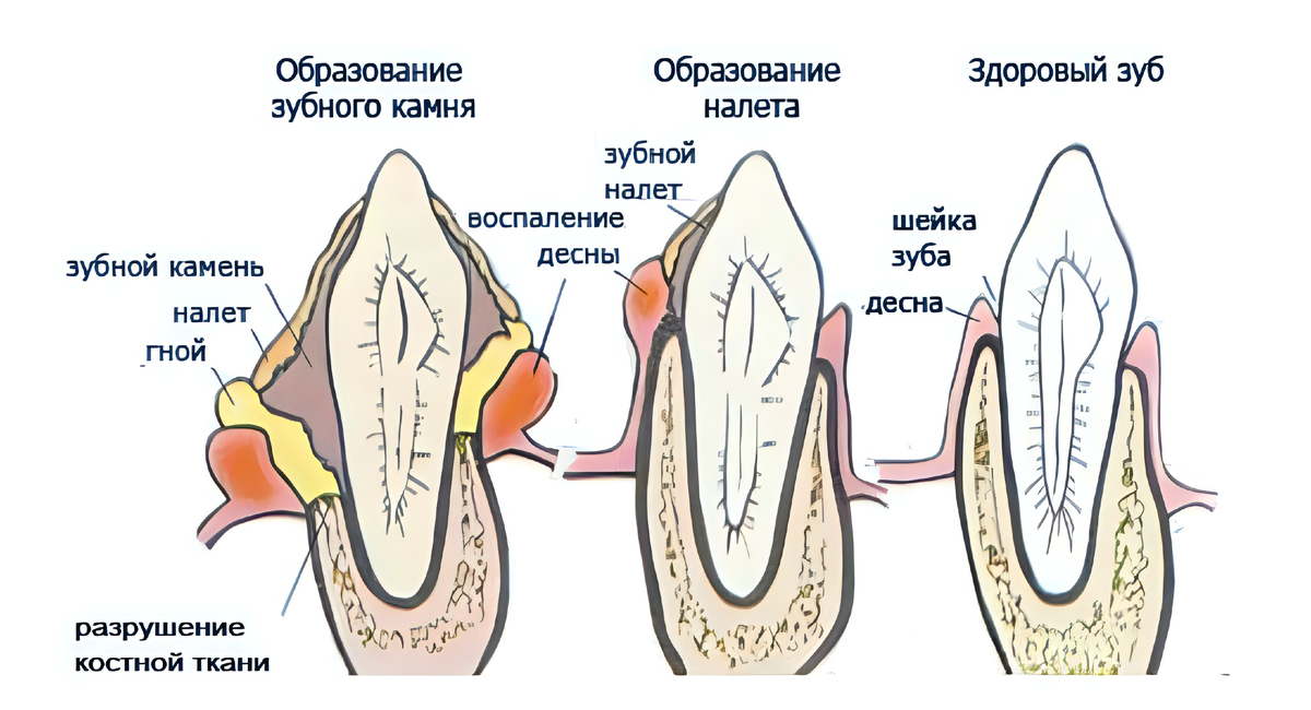 Поддесневой зубной камень. Наддесневой зубной налет. Как выглядит зубной камень у животных.