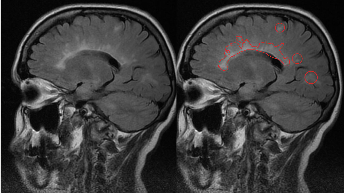Рассеянный склероз на МРТ: как выглядит, диагностика, признаки