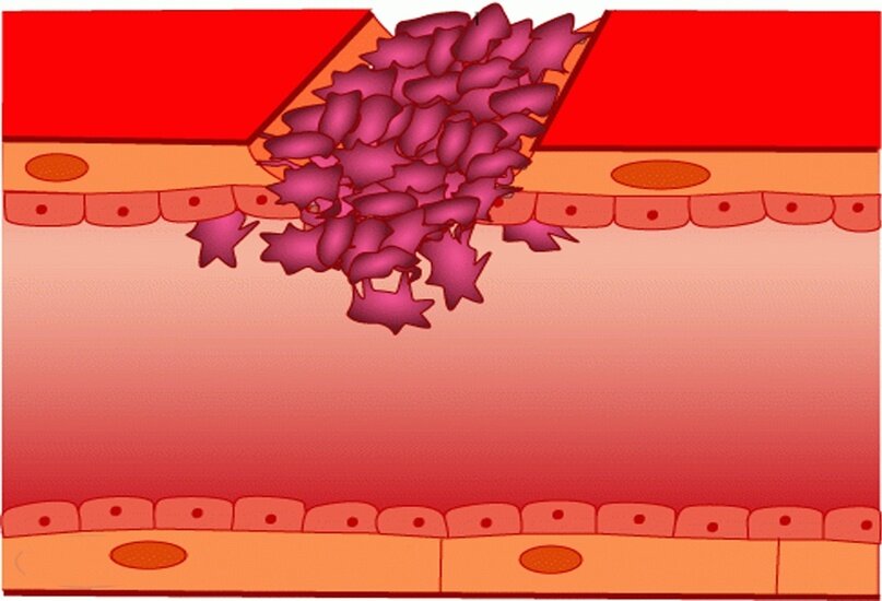 Повреждение сосудистой стенки