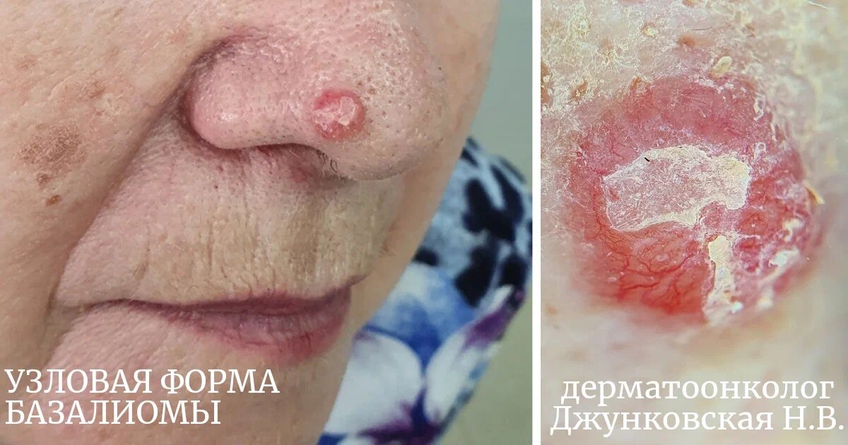 пациентка длительно время считала это родинкой